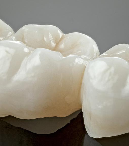 Close-up of dental bridge in Beaverton on grey surface