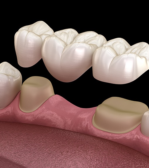 Illustration of a traditional dental implant being placed