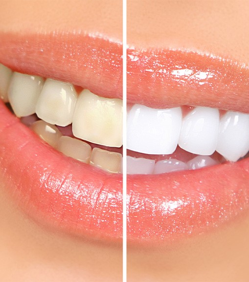 Closeup of smile that’s half whitened to show results