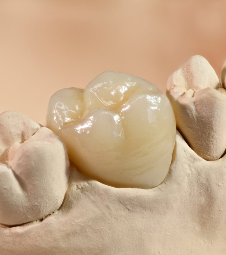 White dental crown in model of the mouth