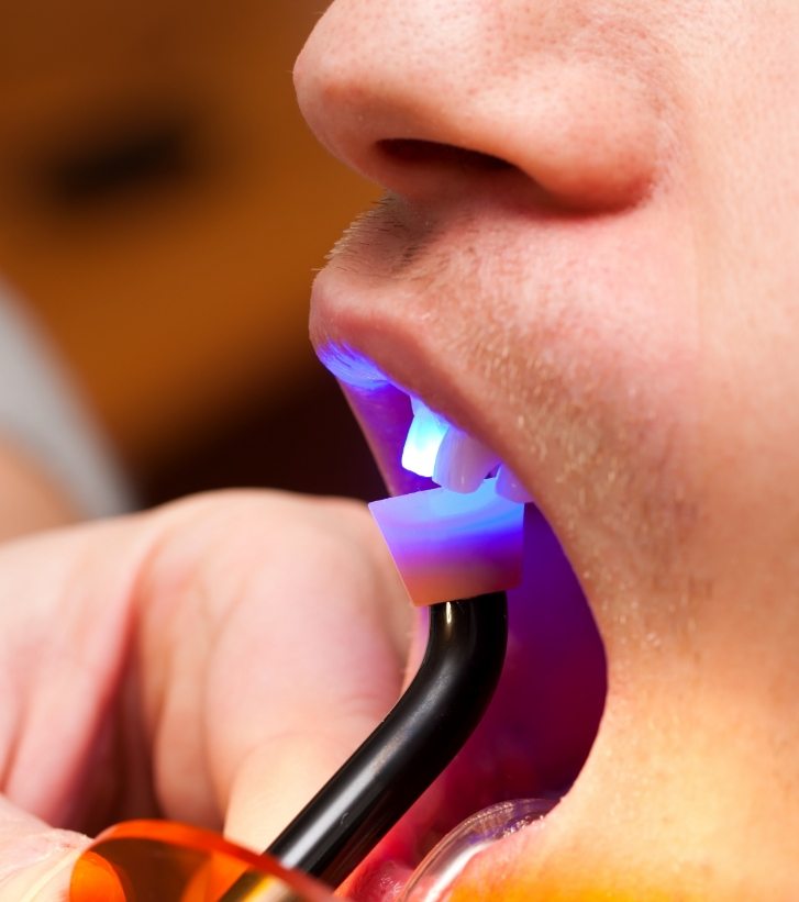 Close up of dental patient getting cosmetic bonding on upper front tooth