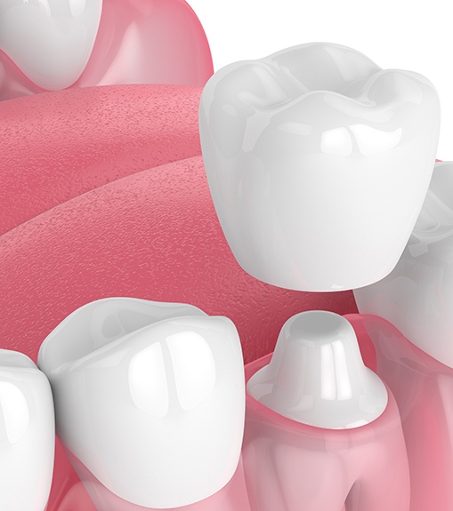 Illustration of crown being placed on tooth