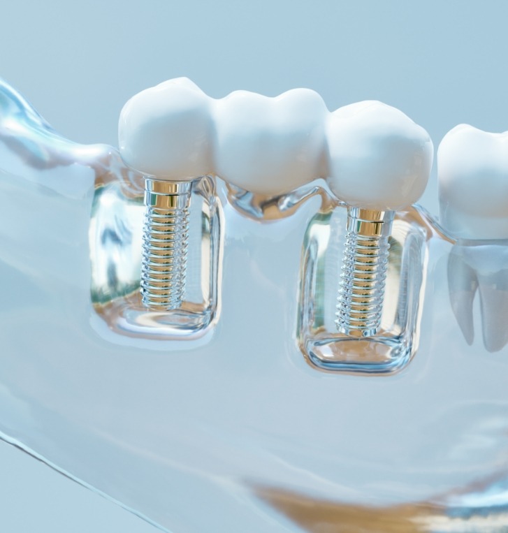 Model of two dental implants in Beaverton replacing three missing teeth