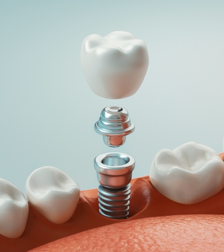 Illustrated dental implant with abutment and dental crown