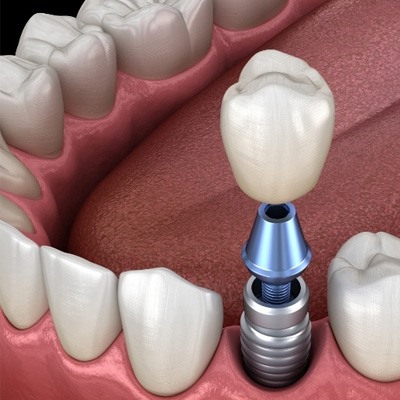 Illustrated dental crown being placed onto a dental implant