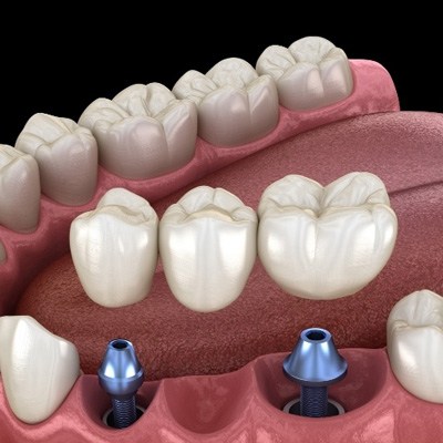 Illustrated dental bridge being placed onto two dental implants