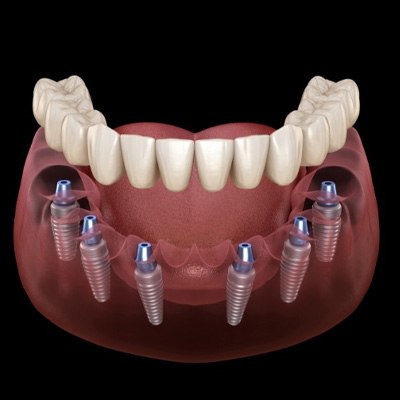 Illustrated full denture being placed onto six dental implants