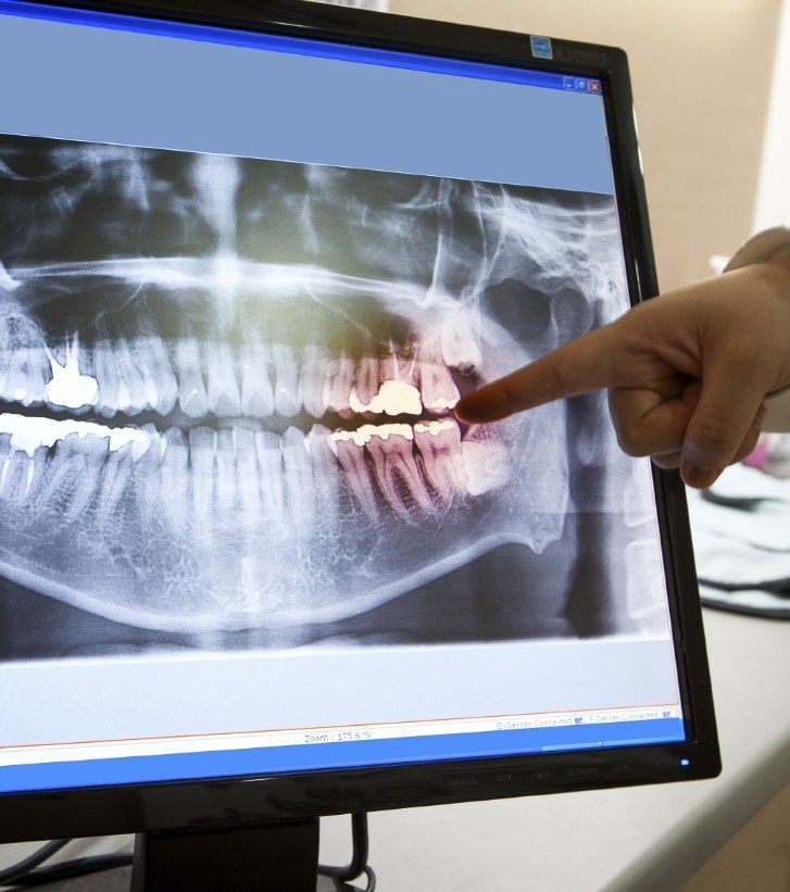 Hand pointing to digital x ray of teeth