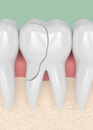 Illustrated close up of a cracked tooth