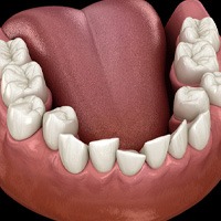 Illustration of crowded teeth