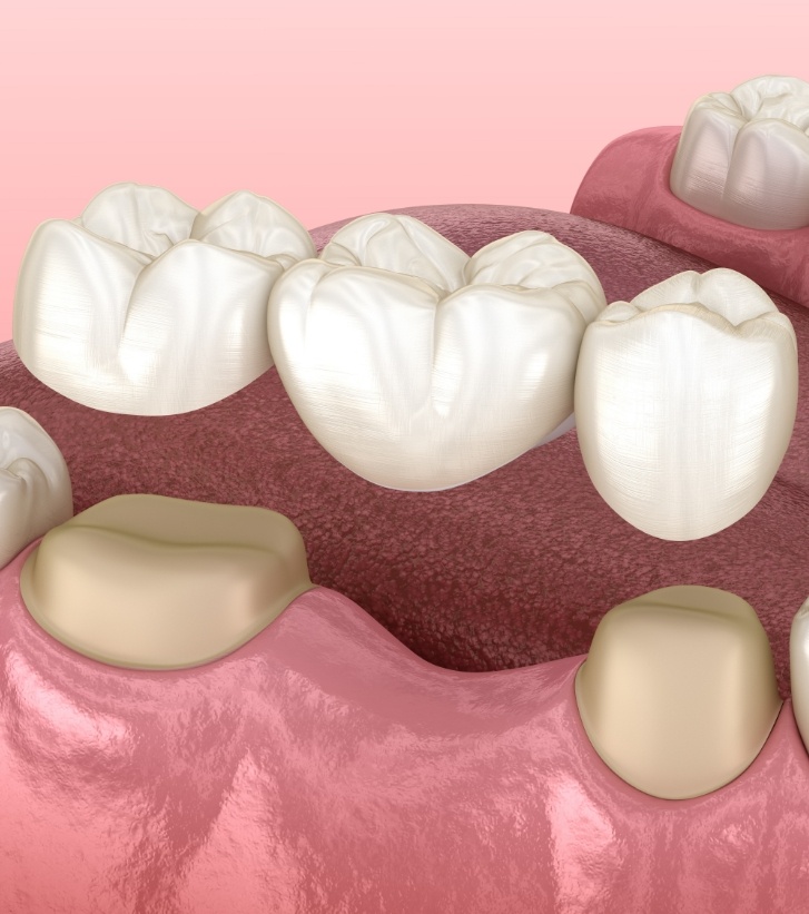 Illustrated dental bridge replacing a missing tooth