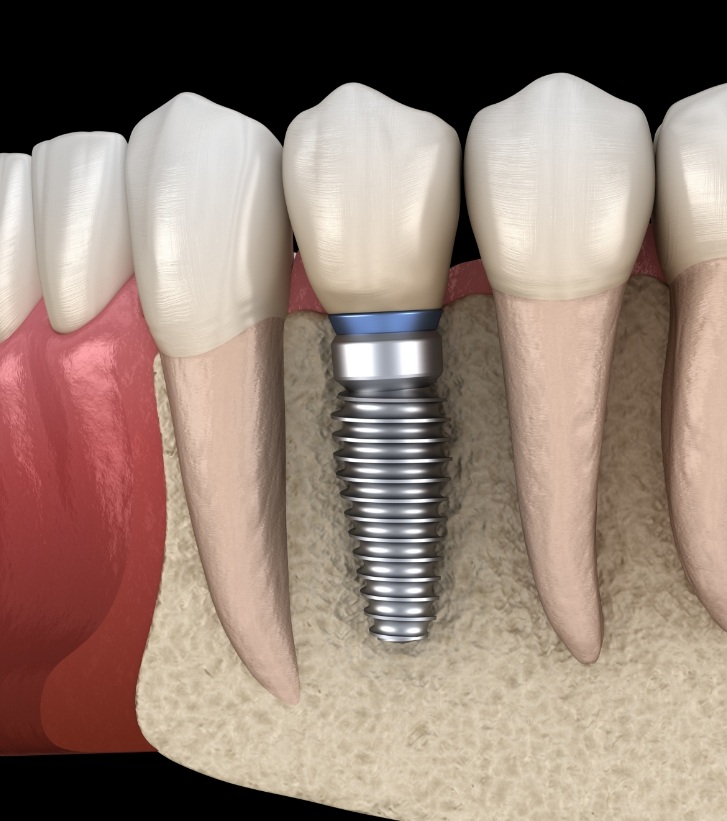 Illustrated dental implant replacing a missing tooth