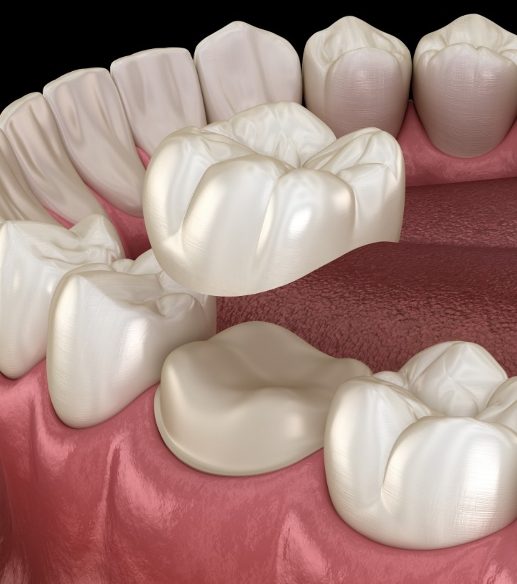 Illustrated dental crown being placed over a tooth