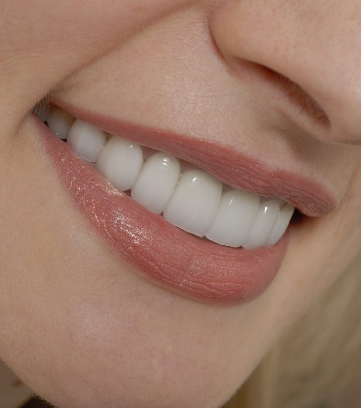 Close up of woman smiling with straight white teeth