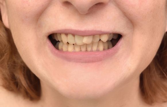 Close up of smile with yellowed teeth