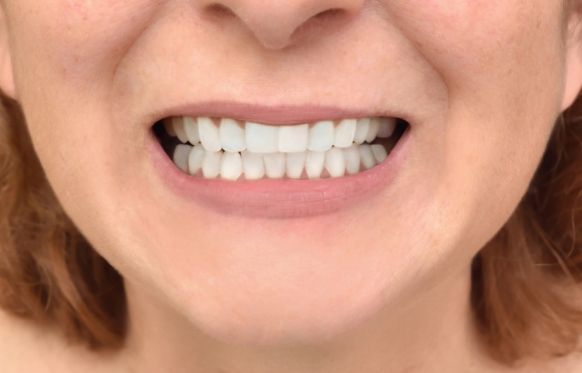 Close up of smile with whiter teeth